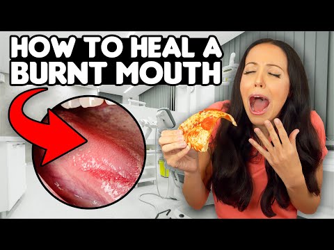 6 QUICK ways to HEAL a BURNT MOUTH