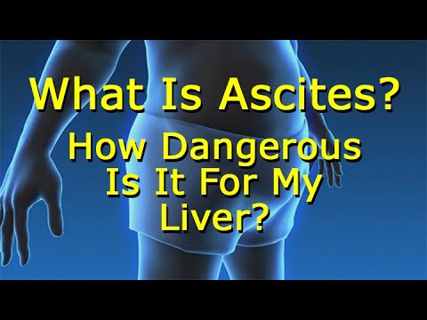 What Is Ascites And How Dangerous Is It For My Liver?