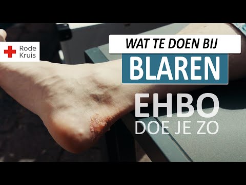 Hoe Haal Je Een Blaar Weg Zonder Pijn Te Doen: 5 Handige Tips