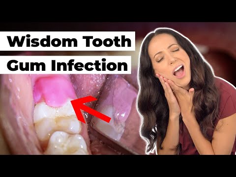 what does this SWOLLEN gum flap mean? (Pericoronitis Explained)