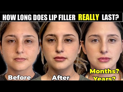 How Long does Lip Filler Last? How Often Should You get Your Lips Redone?