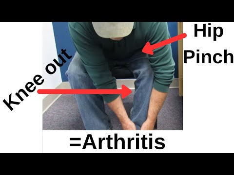 Classic Sign of Hip Arthritis:This is the SIMPLEST test to identify it!