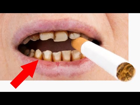 If You Like Your Teeth... STOP Smoking/Vaping