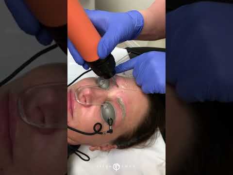 Laser Tattoo Removal for Permanent Eyebrow Makeup | Beverly Hills, CA | Dr. Jason Emer